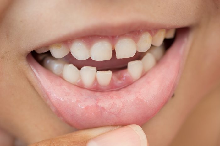Lost milk tooth girl, Close up view.