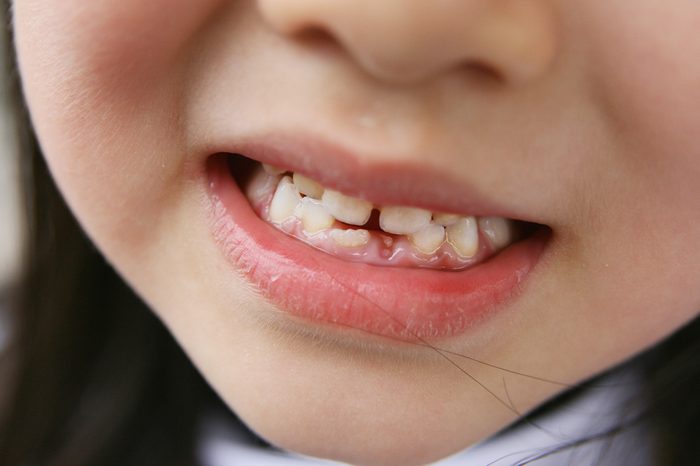 Close-up of a little girl losing two lower milk teeth and a permanent tooth in the shape of a tulip coming in.