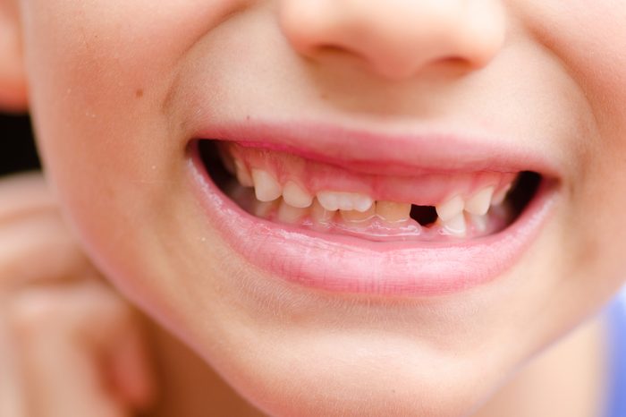 Close up detail portrait of young child with loose and missing milk teeth, happy joyful smiling.