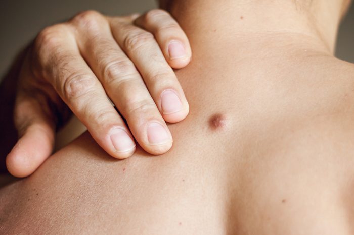 Fibroma on the male back, details, close-up